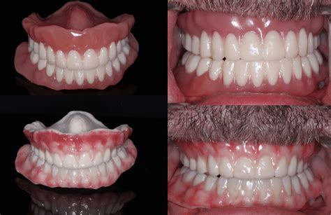3d printed dentures reviews|3D Printed Digital Dentures .